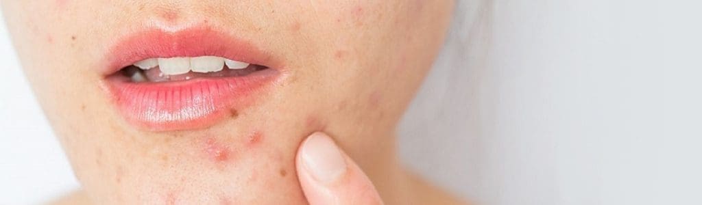 Acne vulgaris