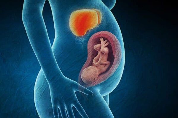 کبد چرب در زنان باردار