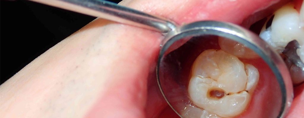 تعریف پوسیدگی دندان