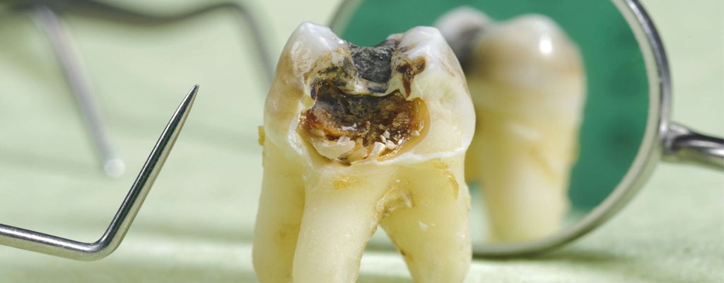 پوسیدگی دندان و  عفونت های ادنتوژنیک چرکی