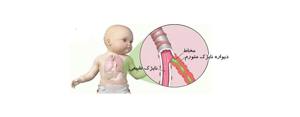 مشخصات بیماری های ریه در کودکان