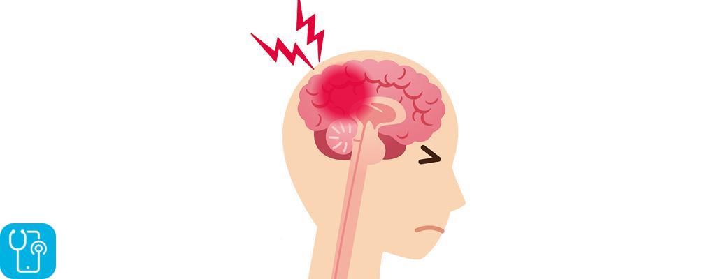 بیشترین علائم سکته مغزی خفیف در بیماران چیست؟