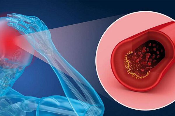 نشانه های سیگار بر افزایش غلظت خون