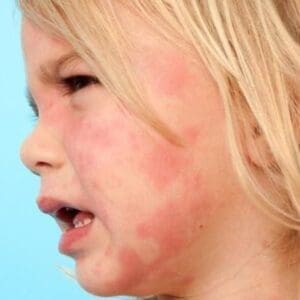 عفونت پوست و بافت نرم در کودکان