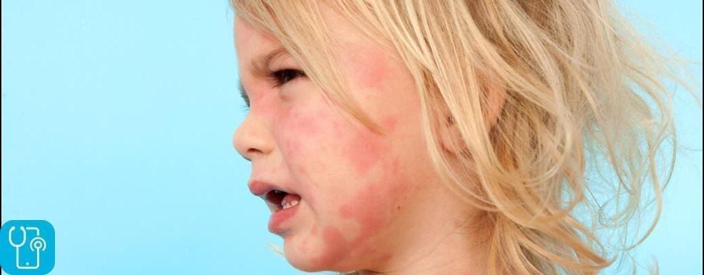 عفونت پوست و بافت نرم در کودکان