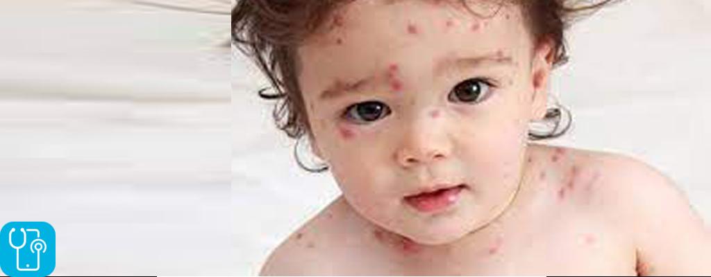 ارزیابی عفونت پوست و بافت نرم در کودکان