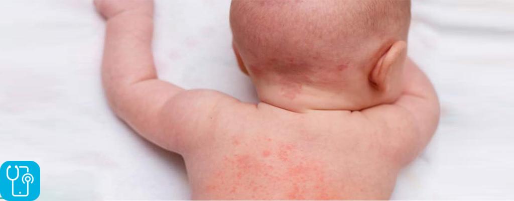 انواع بیماری های پوستی کودکان کدام است؟