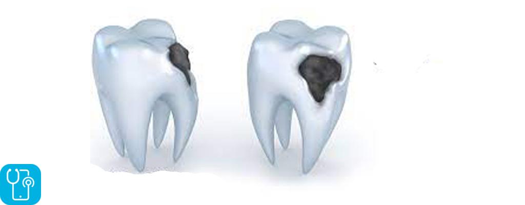 برای جلوگیری از تشکیل حفره ها و پوسیدگی دندان چه کاری می توانم انجام دهم؟