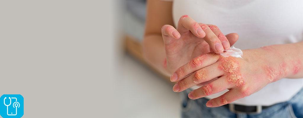 علت و درمان لکه های قرمز روی پوست با ویزیت آنلاین دکتر پوست