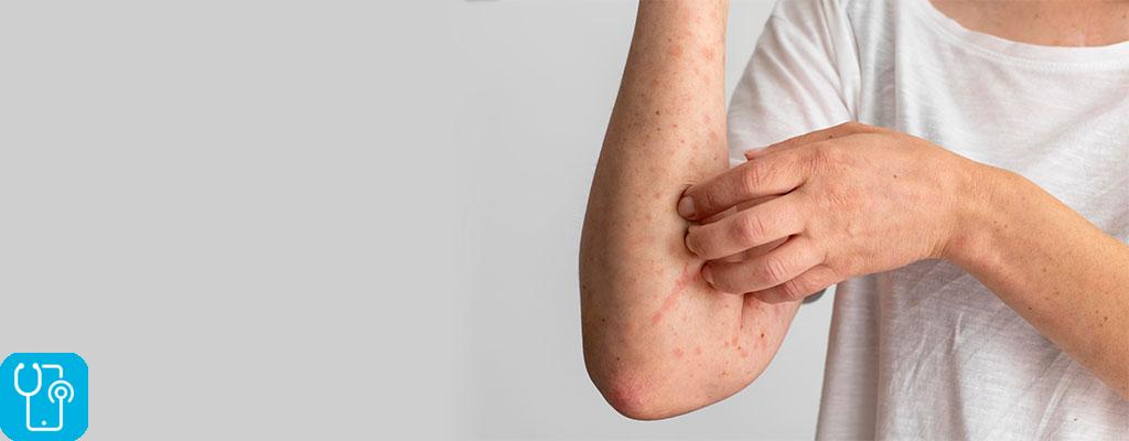 درمان خانگی بیماری پوست مرغی با ویزیت آنلاین متخصص پوست