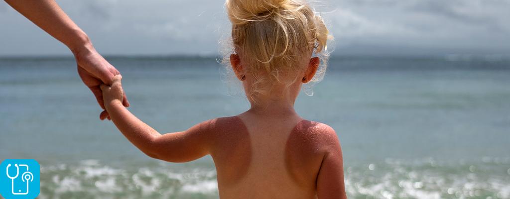 علائم آفتاب سوختگی در کودکان