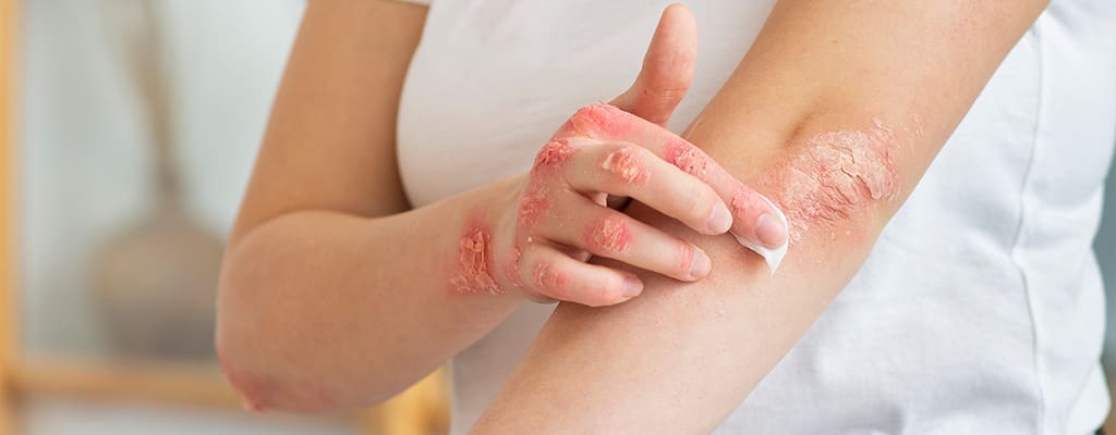 درمان خانگی حساسیت پوستی