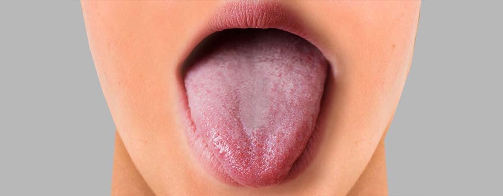 علت لکه های قرمز روی زبان